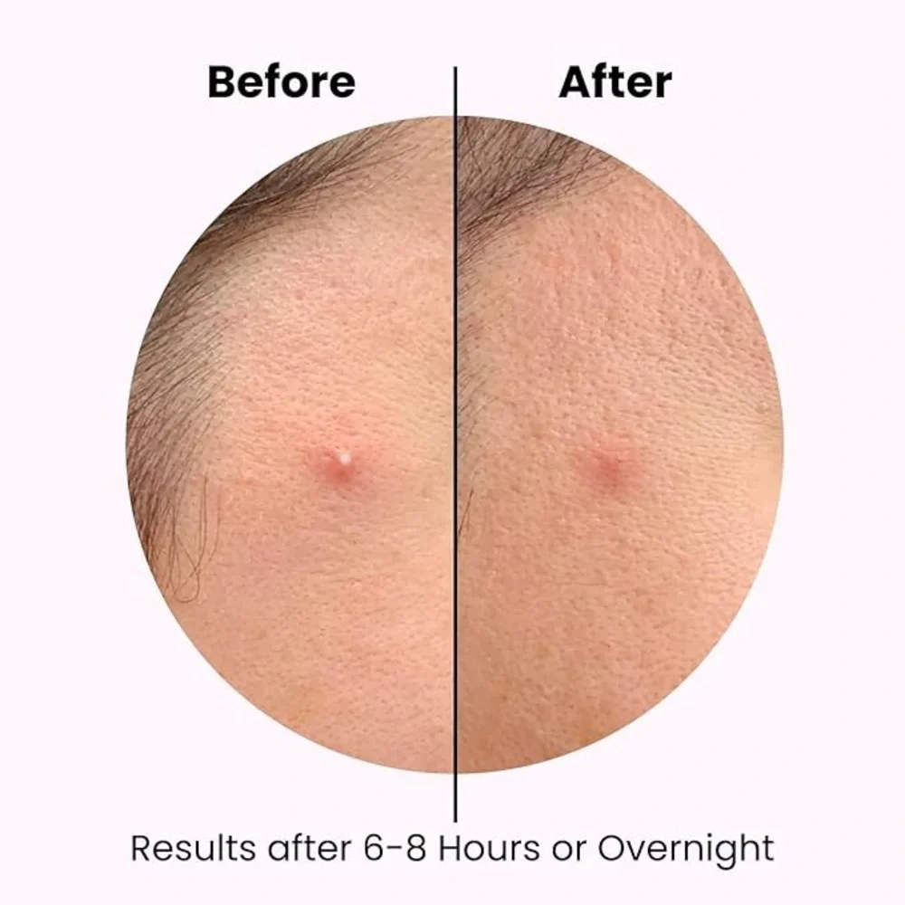 New Hydrocolloid Acne Pimples Patches Invisible Blemish Absorbing Spot Cover